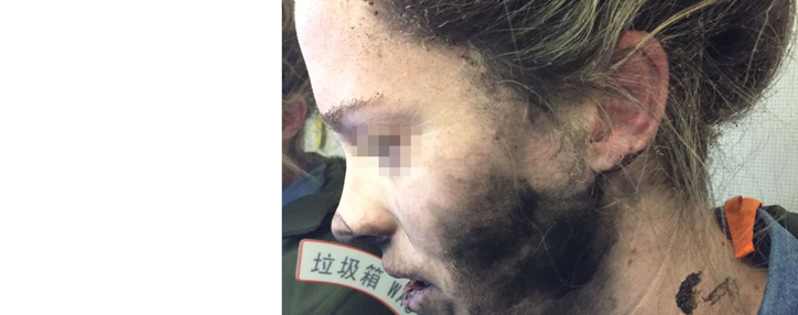 На рейсе в Австралию у пассажирки на голове взорвались наушники